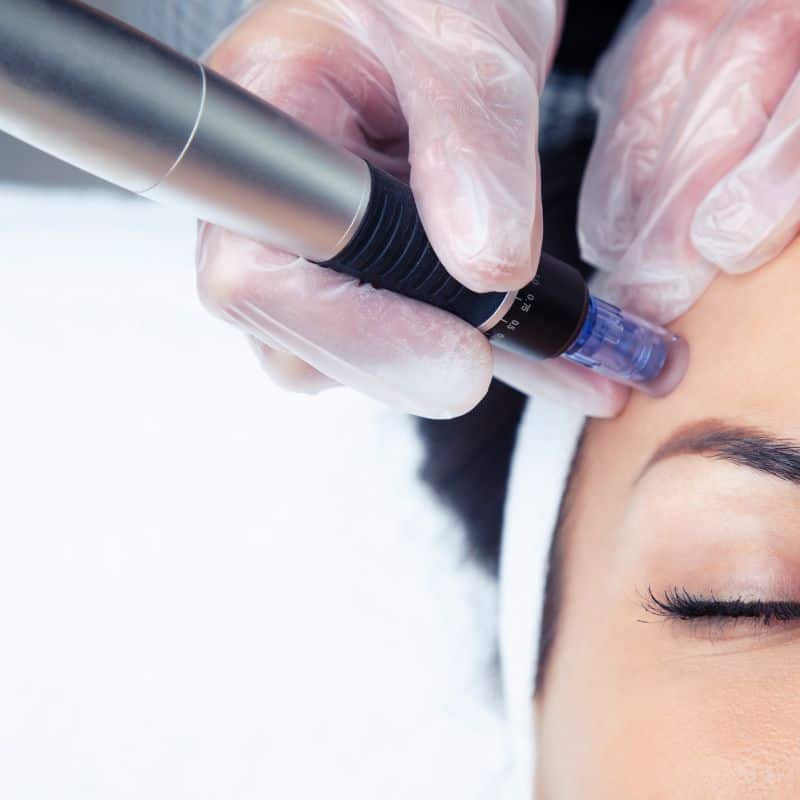 Morpheus8 treatment Bingley from Lipo Sculpt - Book in today!